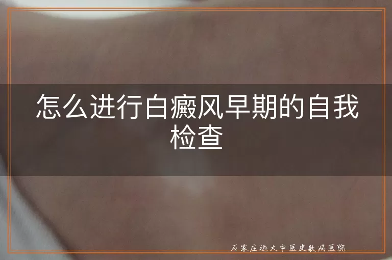 怎么进行白癜风早期的自我检查
