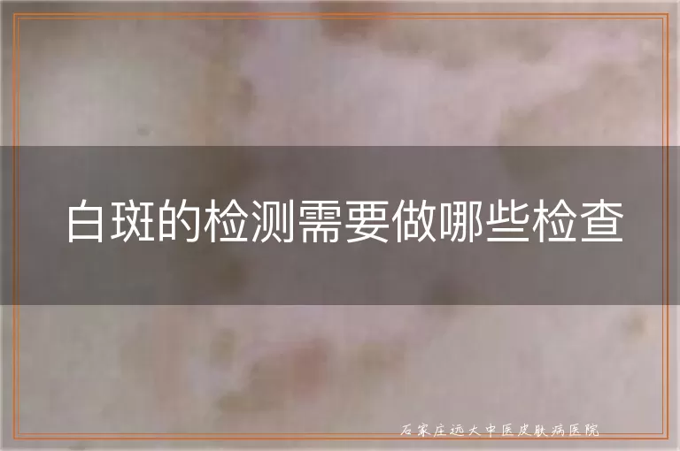 白斑的检测需要做哪些检查