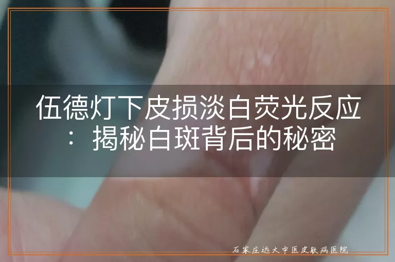 伍德灯下皮损淡白荧光反应：揭秘白斑背后的秘密