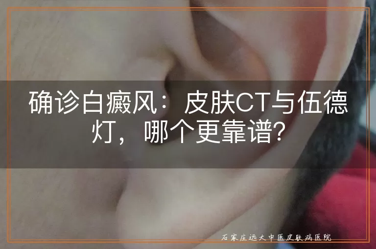 确诊白癜风：皮肤CT与伍德灯，哪个更靠谱？