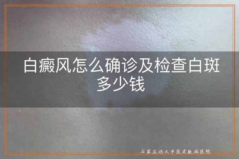 白癜风怎么确诊及检查白斑多少钱