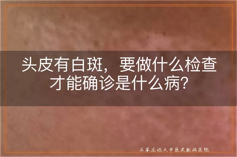 头皮有白斑，要做什么检查才能确诊是什么病？
