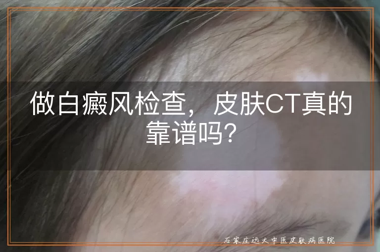 做白癜风检查，皮肤CT真的靠谱吗？