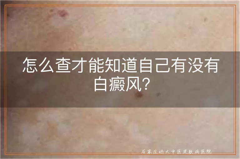 怎么查才能知道自己有没有白癜风？