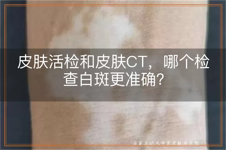 皮肤活检和皮肤CT，哪个检查白斑更准确？