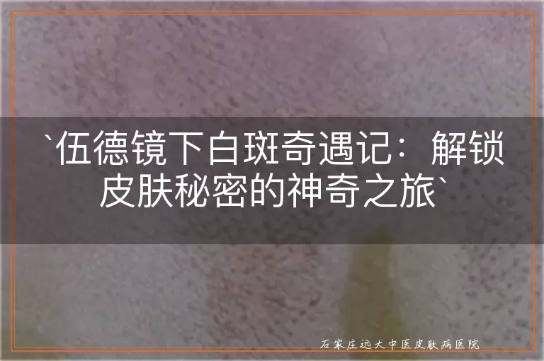 伍德镜下白斑奇遇记：解锁皮肤秘密的神奇之旅