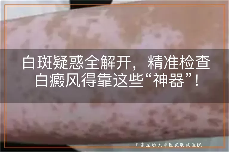 白斑疑惑全解开，精准检查白癜风得靠这些“神器”！