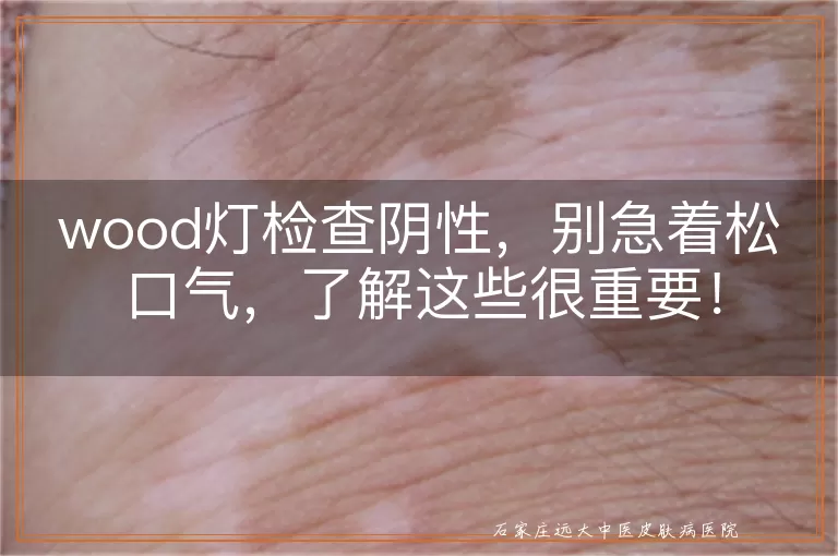 wood灯检查阴性，别急着松口气，了解这些很重要！