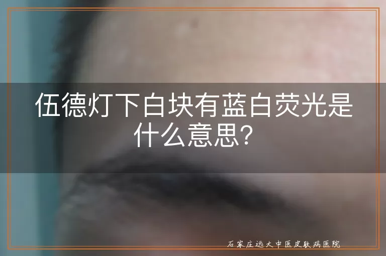 伍德灯下白块有蓝白荧光是什么意思？