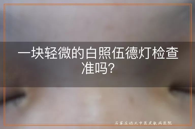 一块轻微的白照伍德灯检查准吗？