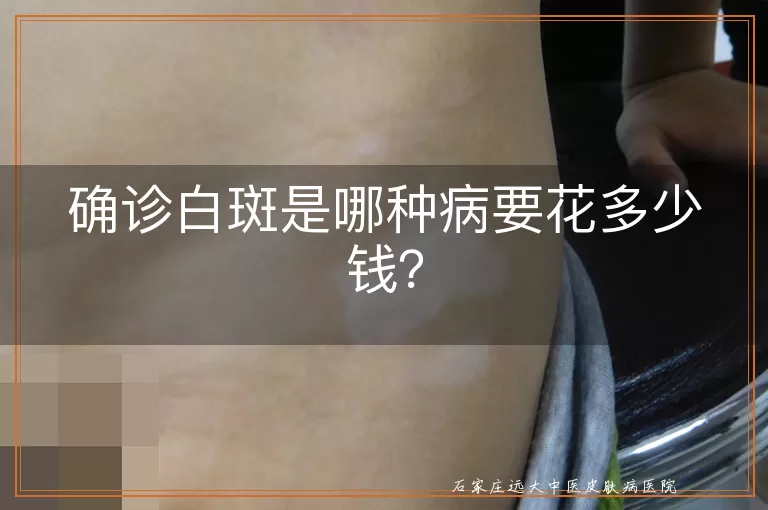 确诊白斑是哪种病要花多少钱？