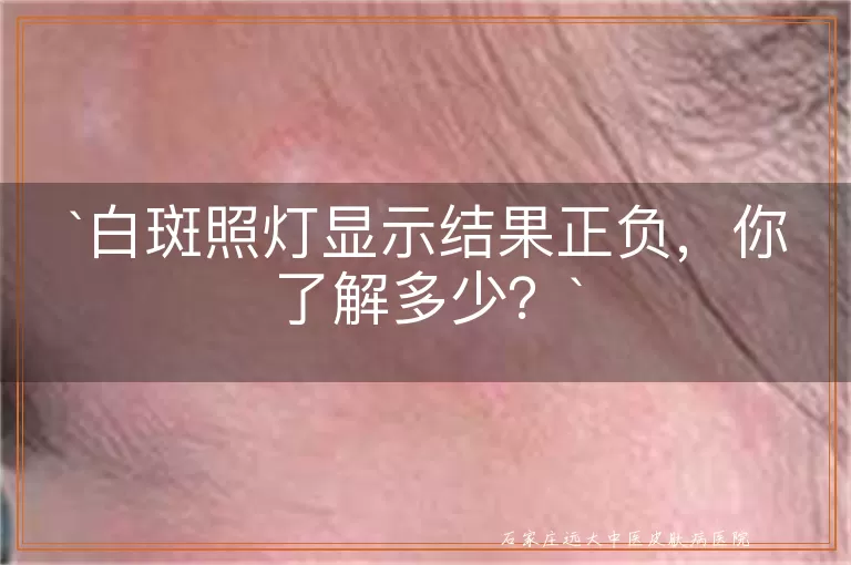 白斑照灯显示结果正负，你了解多少？
