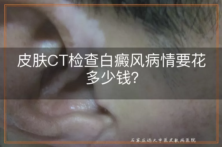 皮肤CT检查白癜风病情要花多少钱？
