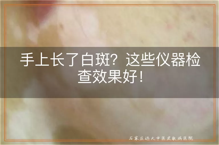 手上长了白斑？这些仪器检查效果好！