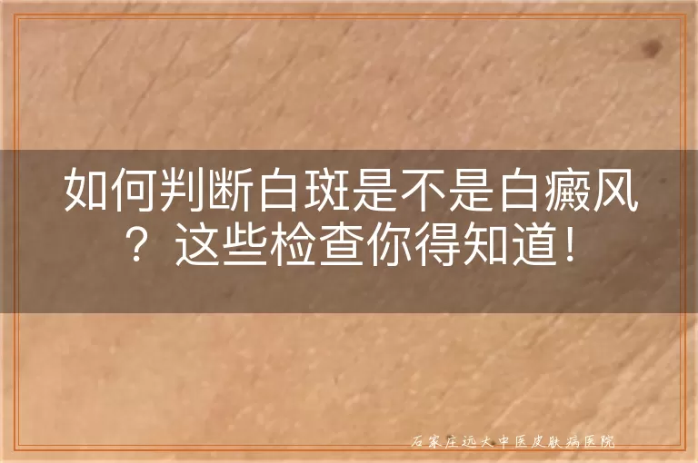 如何判断白斑是不是白癜风？这些检查你得知道！