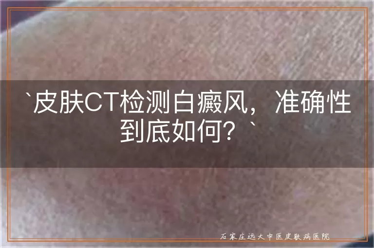 皮肤CT检测白癜风，准确性到底如何？