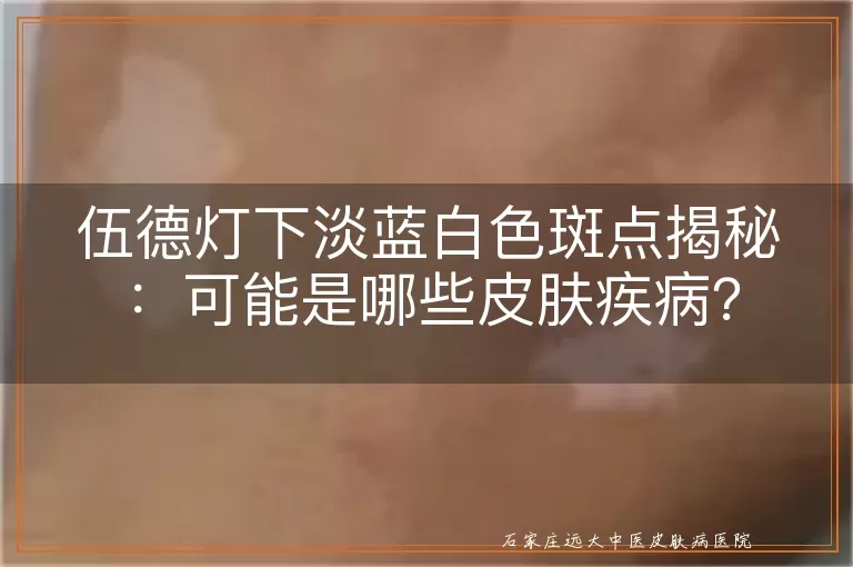 伍德灯下淡蓝白色斑点揭秘：可能是哪些皮肤疾病？