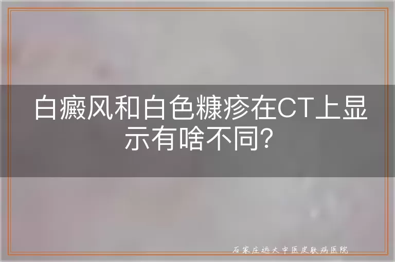 白癜风和白色糠疹在CT上显示有啥不同？