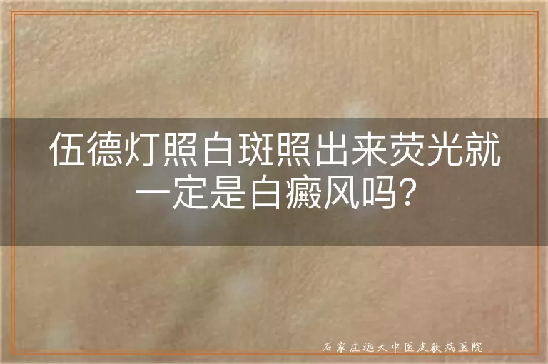 伍德灯照白斑照出来荧光就一定是白癜风吗？