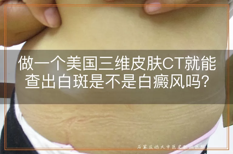 做一个美国三维皮肤CT就能查出白斑是不是白癜风吗？