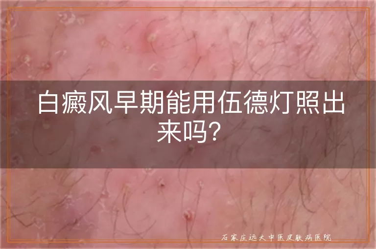 白癜风早期能用伍德灯照出来吗？