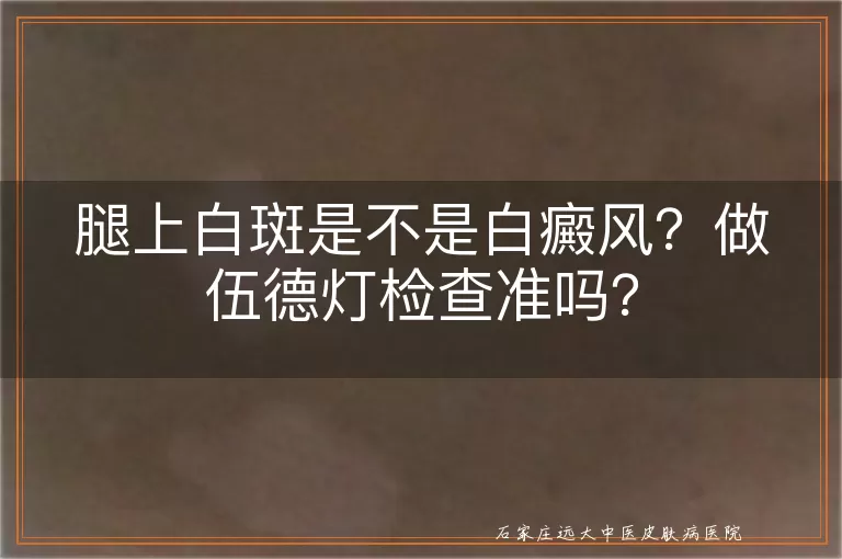 腿上白斑是不是白癜风？做伍德灯检查准吗？