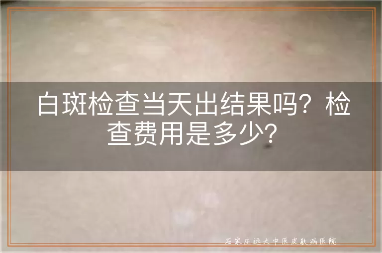 白斑检查当天出结果吗？检查费用是多少？