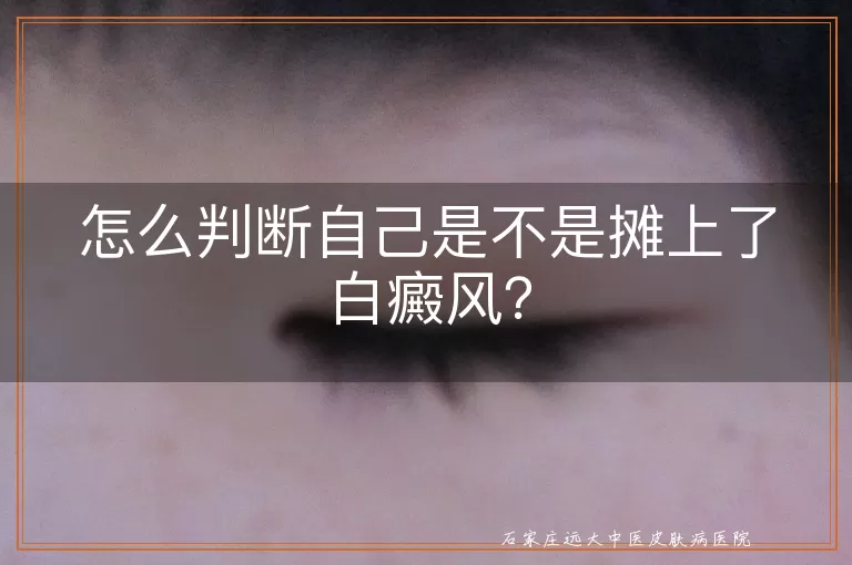 怎么判断自己是不是摊上了白癜风？