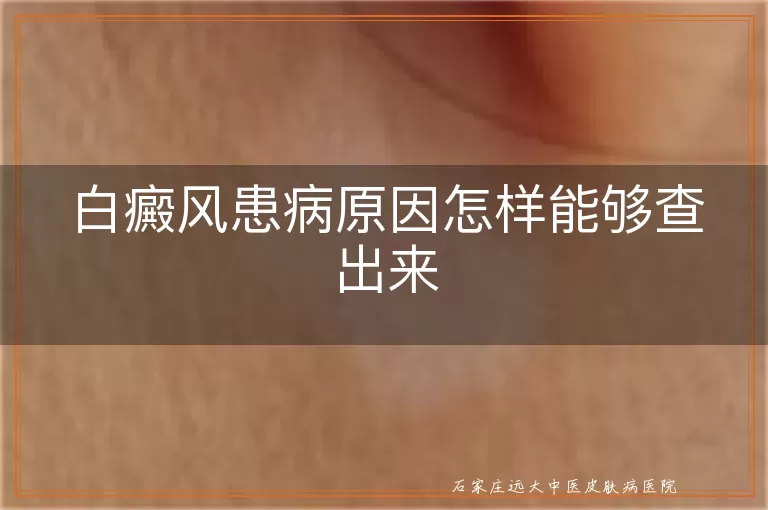 白癜风患病原因怎样能够查出来
