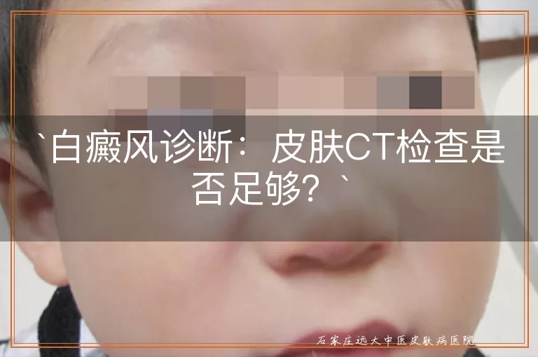 白癜风诊断：皮肤CT检查是否足够？