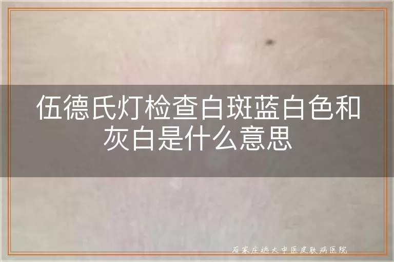 伍德氏灯检查白斑蓝白色和灰白是什么意思