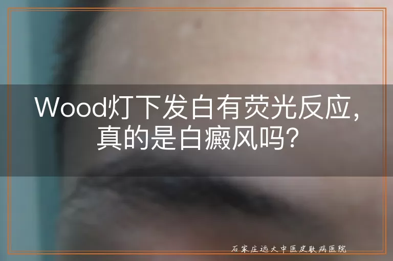 Wood灯下发白有荧光反应，真的是白癜风吗？