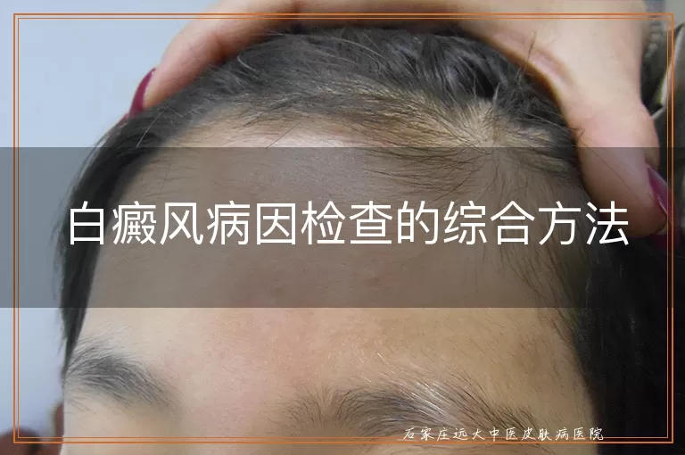 白癜风病因检查的综合方法