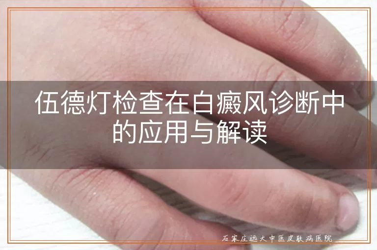 伍德灯检查在白癜风诊断中的应用与解读