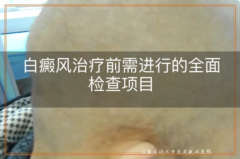 白癜风治疗前需进行的全面检查项目