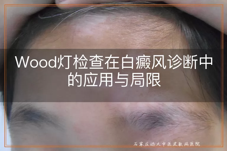 Wood灯检查在白癜风诊断中的应用与局限