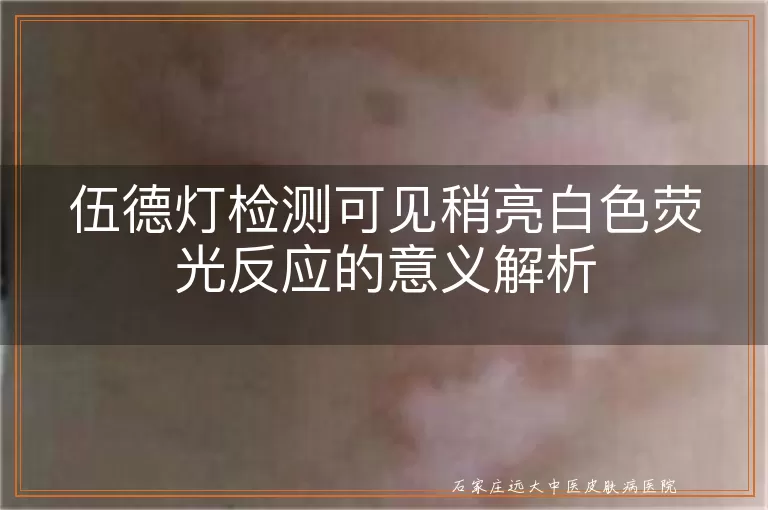 伍德灯检测可见稍亮白色荧光反应的意义解析