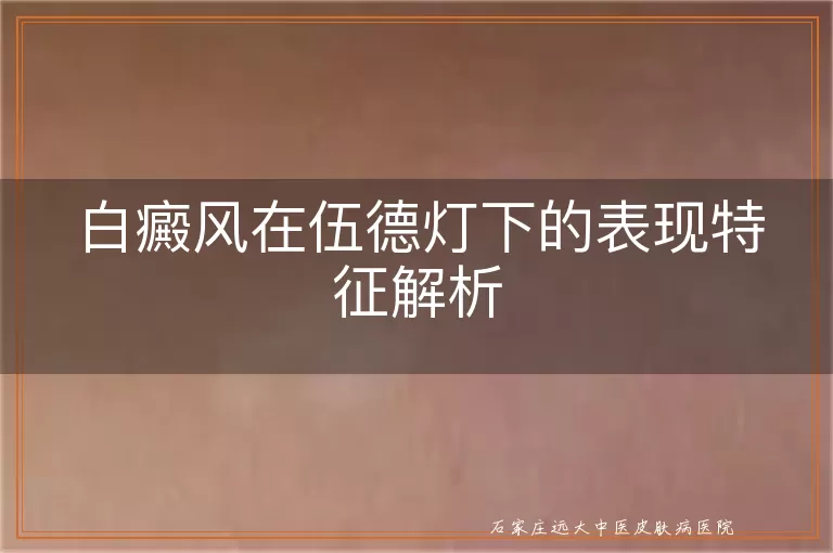 白癜风在伍德灯下的表现特征解析