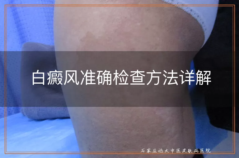 白癜风准确检查方法详解