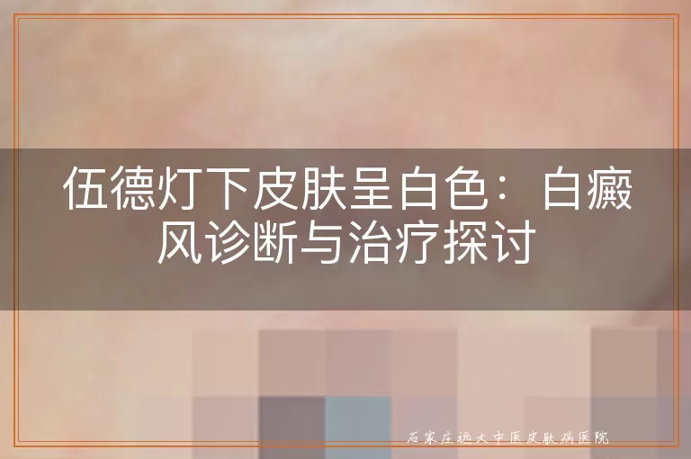 伍德灯下皮肤呈白色：白癜风诊断与治疗探讨