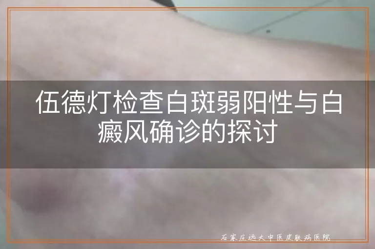 伍德灯检查白斑弱阳性与白癜风确诊的探讨