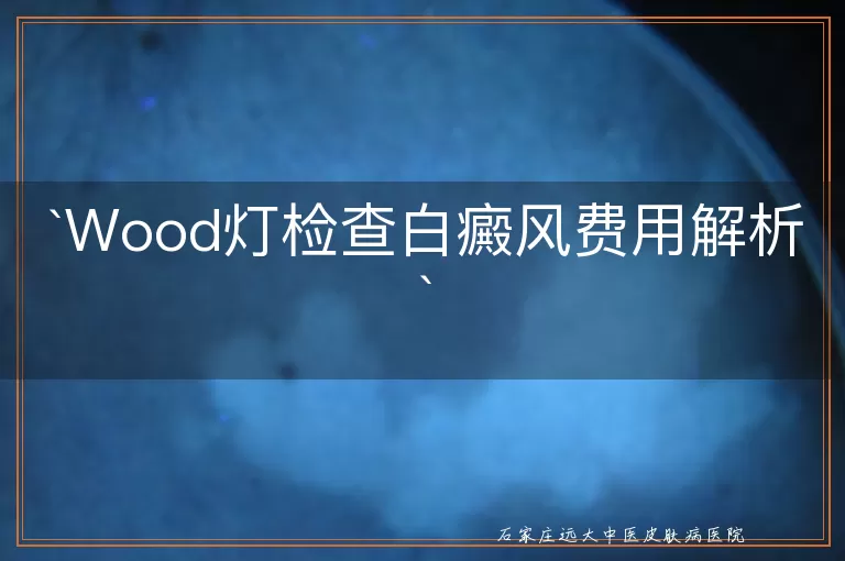 Wood灯检查白癜风费用解析