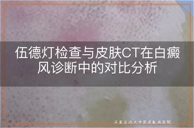 伍德灯检查与皮肤CT在白癜风诊断中的对比分析