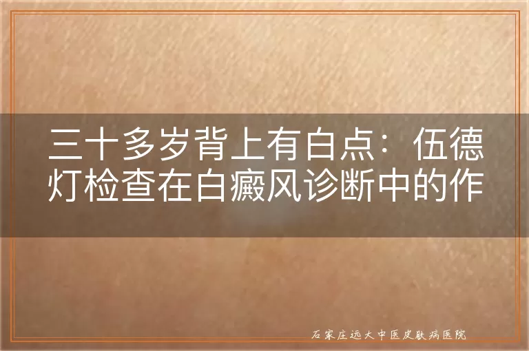 三十多岁背上有白点：伍德灯检查在白癜风诊断中的作用与局限