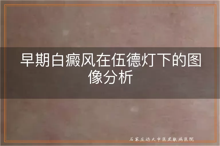 早期白癜风在伍德灯下的图像分析