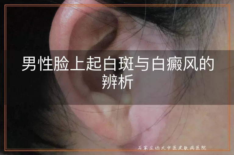 男性脸上起白斑与白癜风的辨析