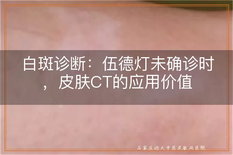 白斑诊断：伍德灯未确诊时，皮肤CT的应用价值