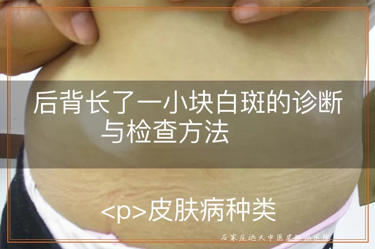 后背长了一小块白斑的诊断与检查方法
<p>皮肤病种类繁多,其中白斑是一种常见的临床表现,可能由多种疾病引起,如白癜风、白色糠疹、花斑癣等。当后背出现一小块白斑时,患者往往感到担忧,希望通