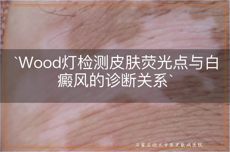Wood灯检测皮肤荧光点与白癜风的诊断关系