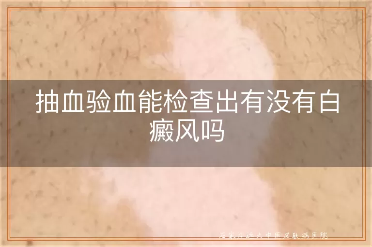 抽血验血能检查出有没有白癜风吗